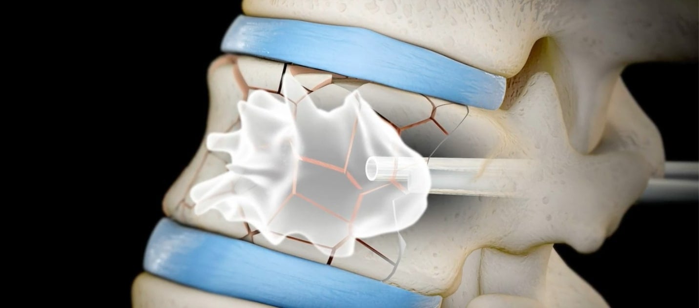 Cifoplastia injectarea cimentului