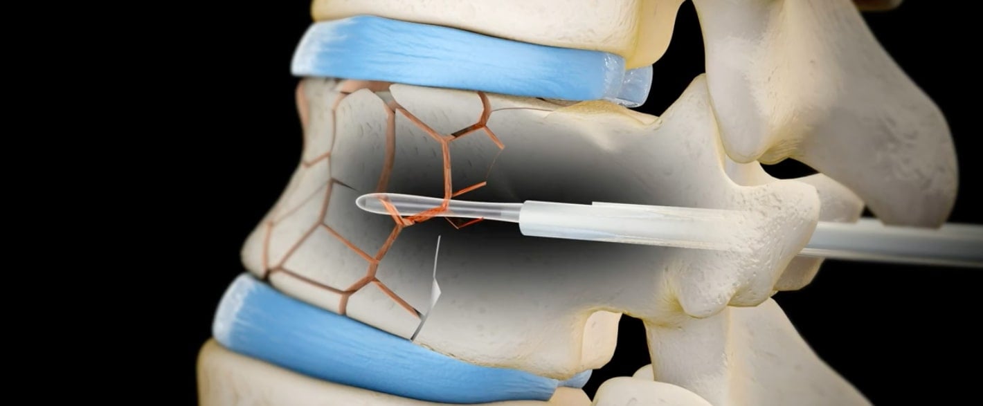 Vertebroplastia finalizare