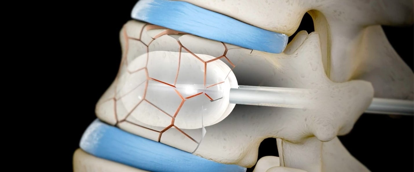Vertebroplastia finalizare2