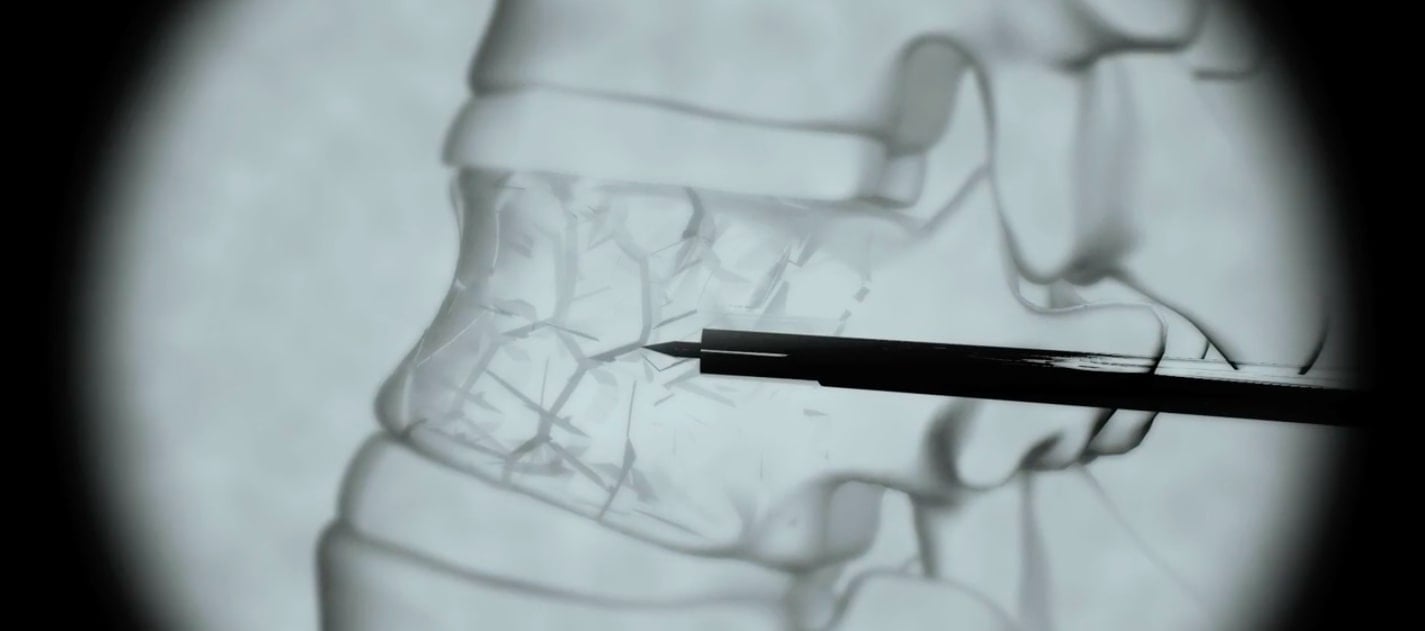 Vertebroplastia injectarea cimentului