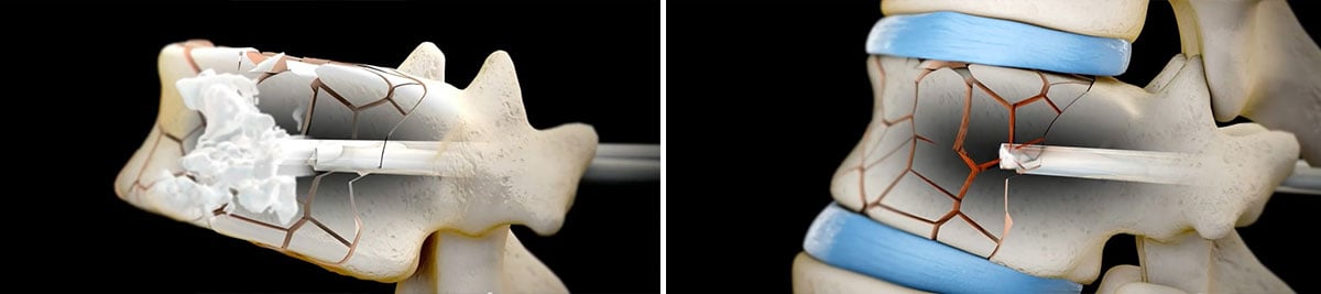 Vertebroplastia-injectarea-cimentului2