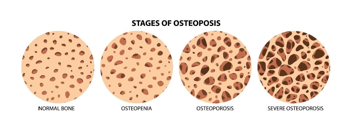 ce este fractura vertebrala osteoporotica