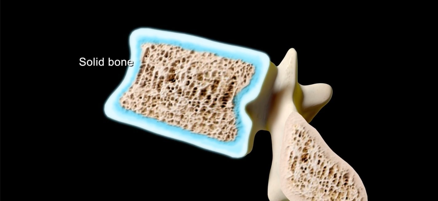 fractura vertebrala solid bone