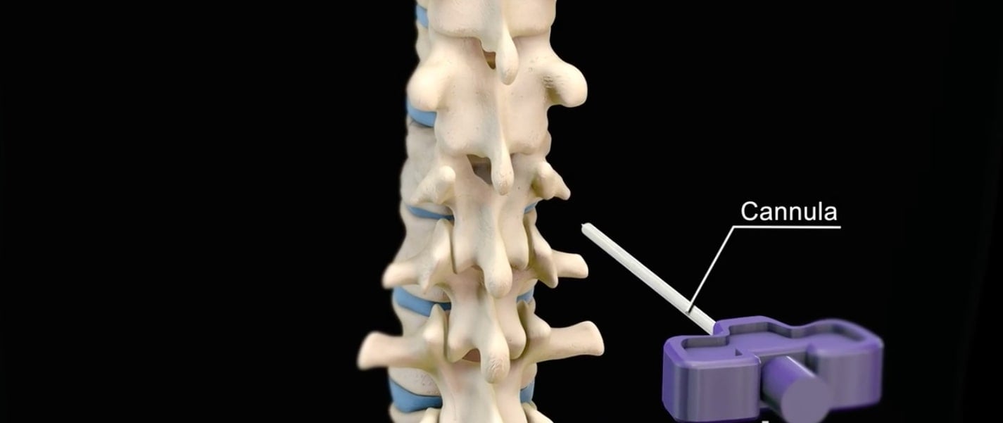 vertebroplastia si cifoplastia cannula