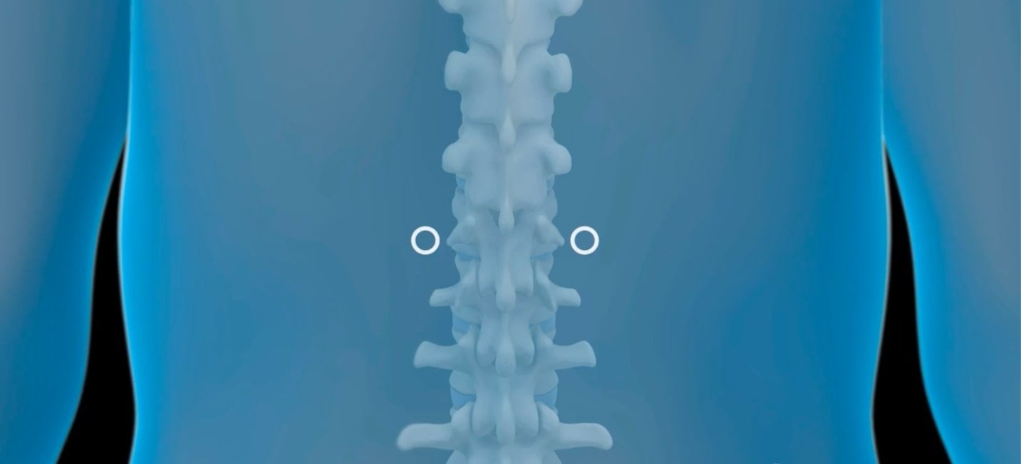 vertebroplastia si cifoplastia