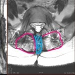 Chirurgia Lombară Eșuată O Patologie Frecventă și Soluția Modernă prin Abord Ultra-Lateral
