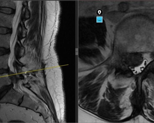 Studiu de caz: Hernie de hisc lombară recidivată L4–L5 tratată prin chirurgie ULTRA laterală minim invazivă – Caz din București, tratat la ANSI Constanța