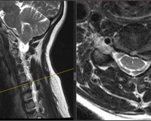 Studiu de caz: Spondiloză cervicală cu compresie medulară tratată prin decompresie ultra-laterală minim-invazivă – Recuperare neurologică rapidă