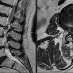 Stenoză lombară recurentă la 78 de ani tratament modern prin tehnica Ultra minim invaziva