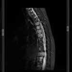Studiu de caz - Durerea de spate nocturnă la pacientele cu cancer de sân când poate indica metastaze la nivelul coloanei vertebrale