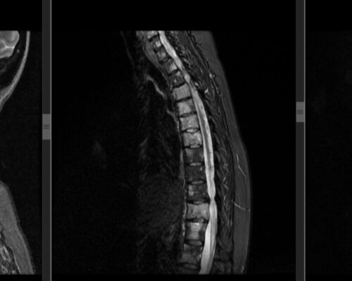 Studiu de caz: Durerea de spate nocturnă la pacientele cu cancer de sân – când poate indica metastaze la nivelul coloanei vertebrale