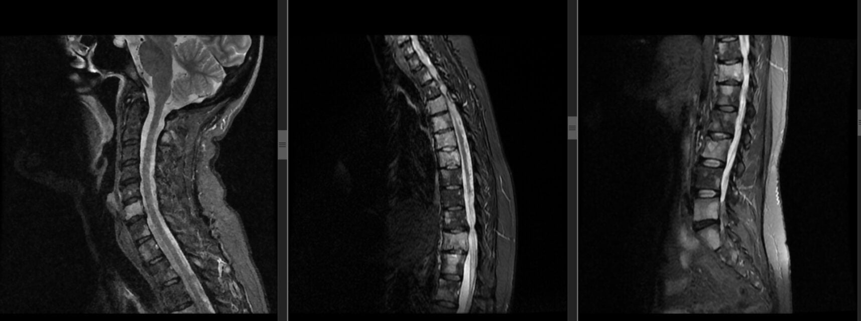 Studiu de caz - Durerea de spate nocturnă la pacientele cu cancer de sân când poate indica metastaze la nivelul coloanei vertebrale