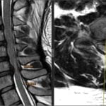 Studiu de caz Hernie de disc cervicală multietajată tratată prin artroplastie cervicală anterioară pe 3 niveluri la un pacient de 33 de ani, medic stomatolog din Franța