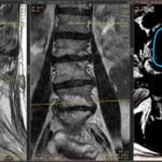 Studiu de caz Recidiva herniei de disc, cum poate fi tratată eficient chiar și după intervenții multiple