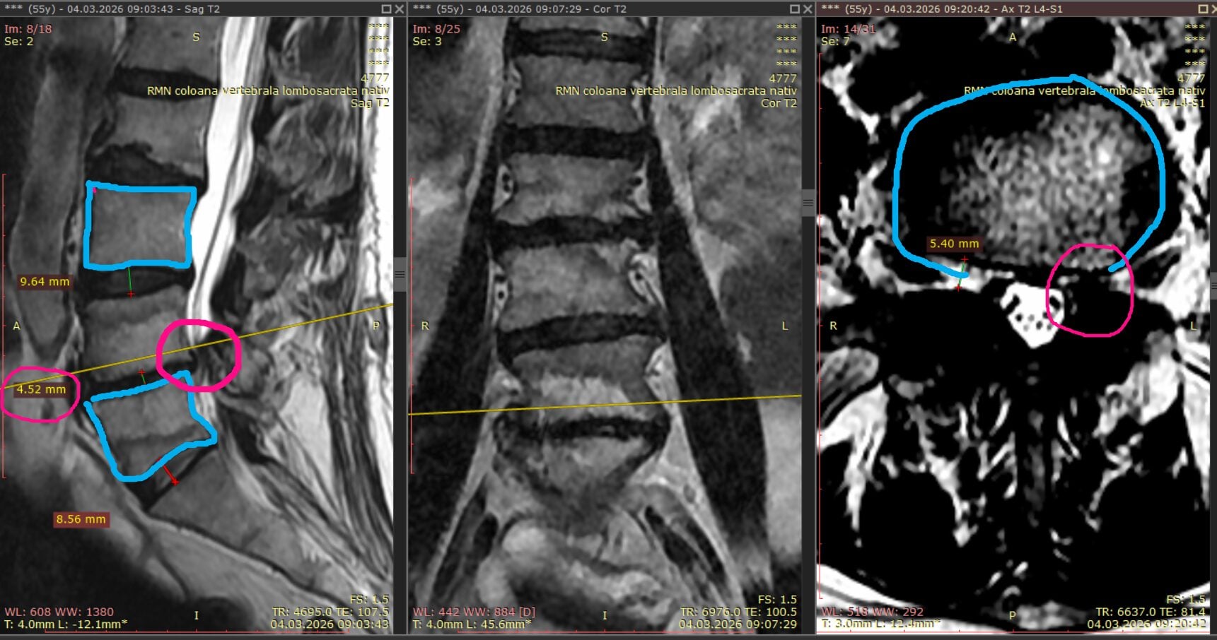 Studiu de caz Recidiva herniei de disc, cum poate fi tratată eficient chiar și după intervenții multiple