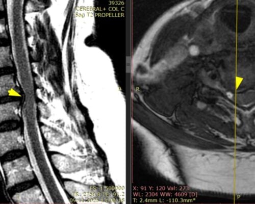 Studiu de caz: Spondiloză cervicală tratată prin abord anterior ultra-minim invaziv – decompresie și stabilizare cu recuperare rapidă