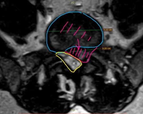 Studiu de caz: Tratamentul herniei de disc lombare prin abord ultra-lateral – Chirurgie minim invazivă la Clinica ANSI din România