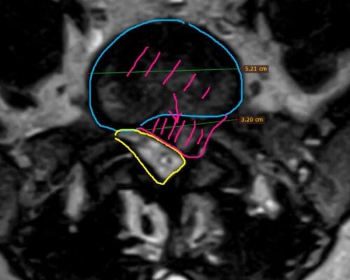 Tehnica ULTRA de Microdiscectomie Lombară: Rezultate pe 973 de Pacienți — Studiu Publicat în International Journal of Spine Surgery