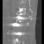 Studiu de caz Tratamentul scoliozei degenerative la adulți după operații lombare corectare minim invazivă prin tehnica ultra-laterală