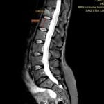 Studiu de caz fractura vertebrala osteoporotica tratata prin tehnica ultra minim invaziva percutana