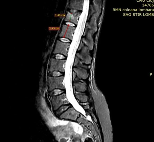 Studiu de caz fractura vertebrala osteoporotica tratata prin tehnica ultra minim invaziva percutana