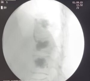 Studiu de caz fractura vertebrala osteoporotica tratata prin tehnica ultra minim invaziva percutana 1