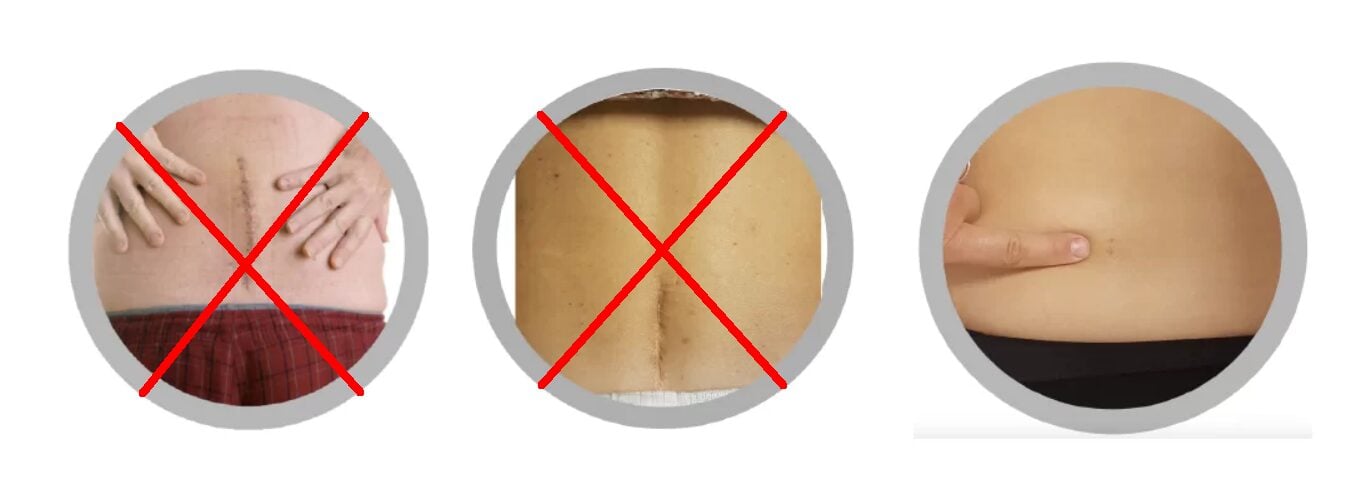 chirurgie spinala tehnici diferite