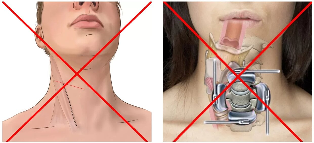 protezare-cervicala-tratament-clasic-2b