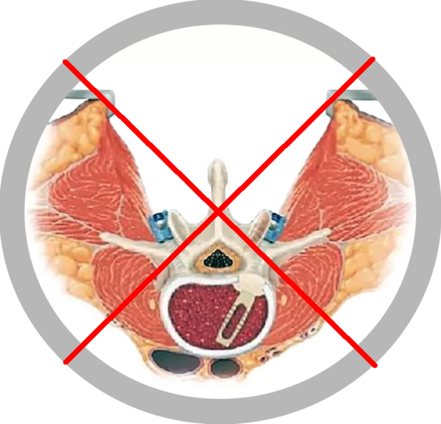 protezare spinala - tehnica clasica (2)