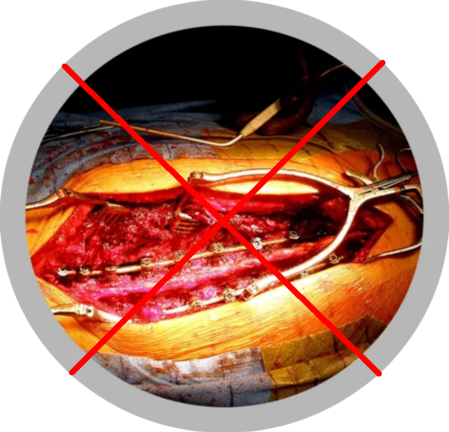 protezare spinala - tehnica clasica (3)