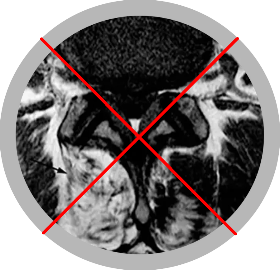 protezare spinala - tehnica clasica (4)